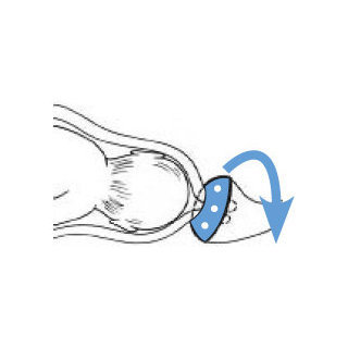 Placement du pessaire de cerclage pour soutenir le col de l'utrus pendant la grossesse