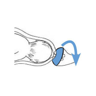 Positionnement du pessaire de cerclage pour les grossesses difficiles