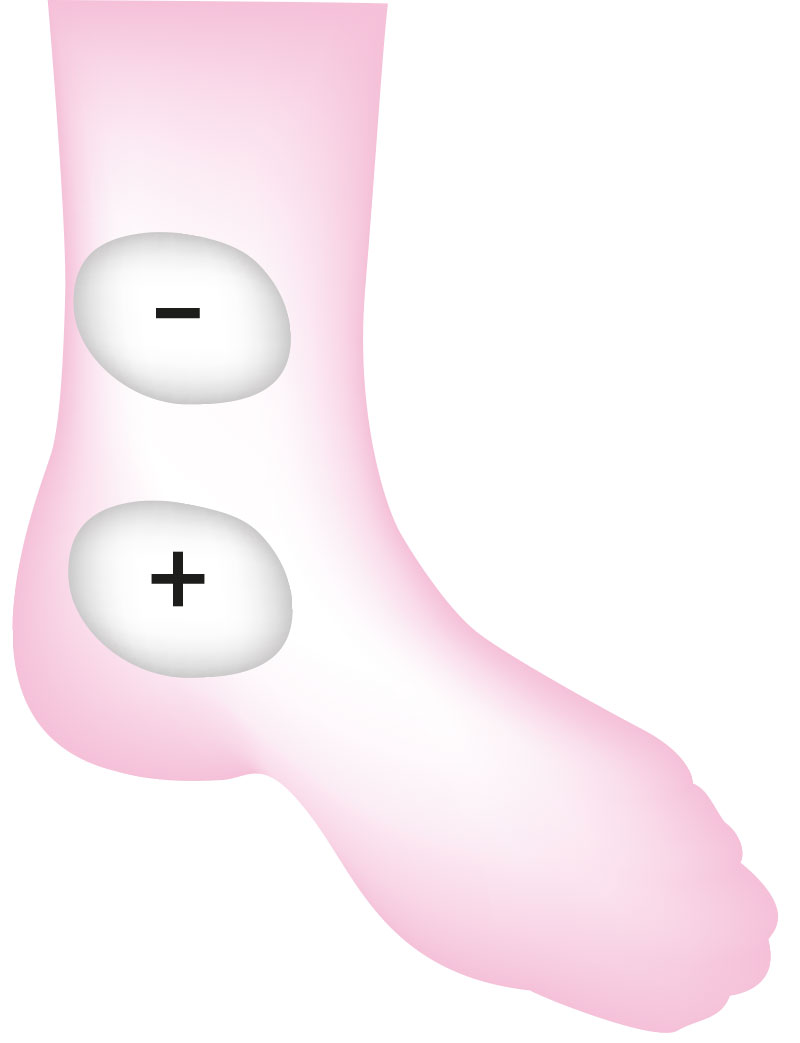 Stimulation du nerf tibial postérieur appelé aussi SPI