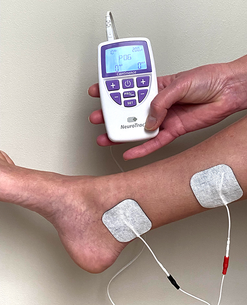 Positionnement des électrodes pour la stimulation du nerf tibial postérieur