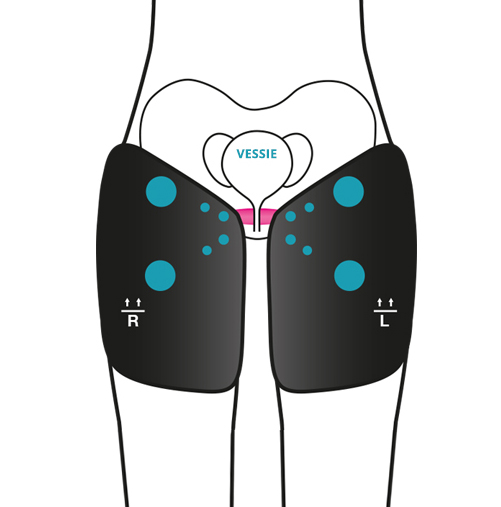 Innovo, système de rééducation périnéale externe