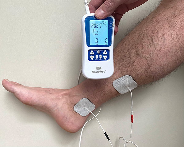 La stimulation du nrf tibial postérieur avec électrode pour l'hyperactivité de la vessie