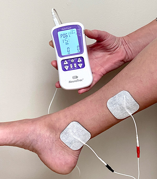 La stimulation du nrf tibial postérieur avec électrode pour l'hyperactivité de la vessie