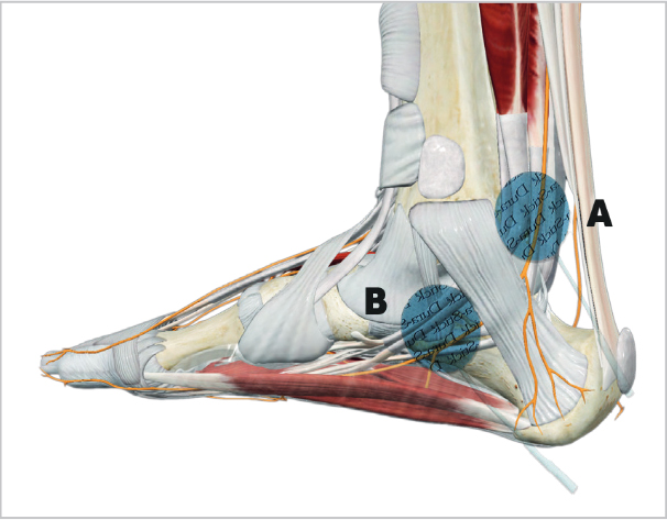 Position des électrodes pour la stimulation du nerf tibial postérieur avec l'appareil Cefar URO®