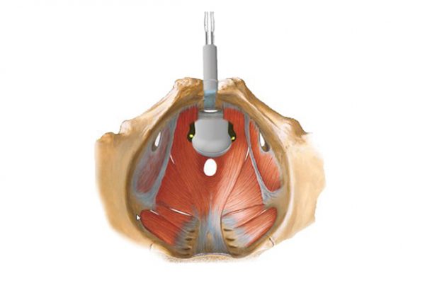 Utilisation et positionnement de la sonde périnéale persiphera U avec ses 4 electrodes