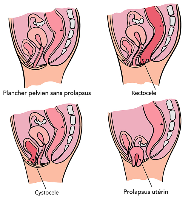 Les prolapsus les plus courants : cystocèle, rectocèle, prolapsus utérin