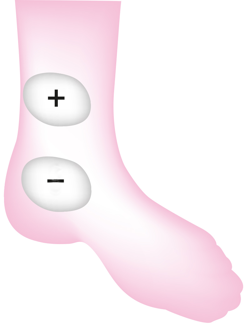 Position des électrodes pour la stimulation du nerf tibial postérieur