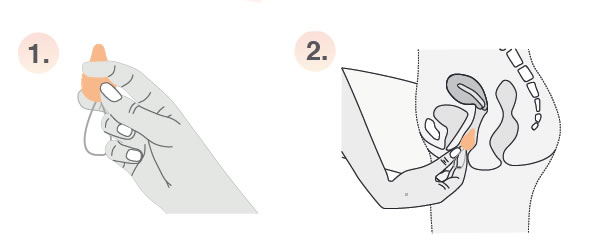 Comment insérer le Pelvix Concept