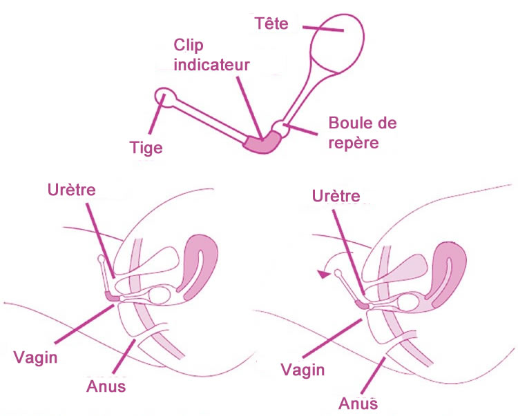 Mode d'emploi des cônes vaginaux Kegel 8 Comment bien utiliser les cônes vaginaux Kegel 8